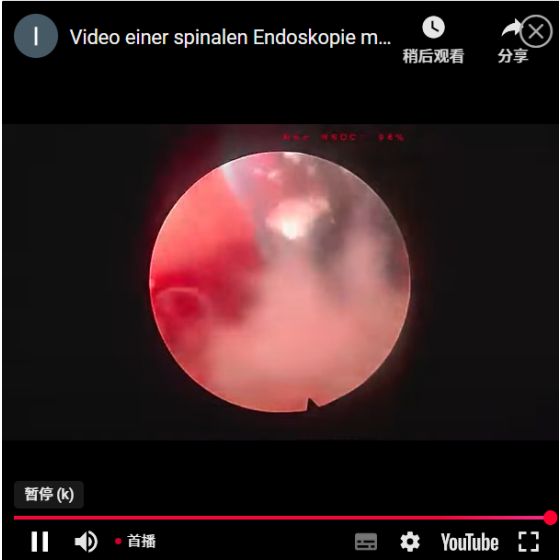 Single-portal full-process decompression video of spinal endoscopy
